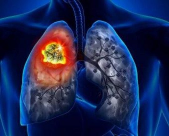 غربالگری سی تی اسکن موجب بهبود عوارض سرطان ریه می شود